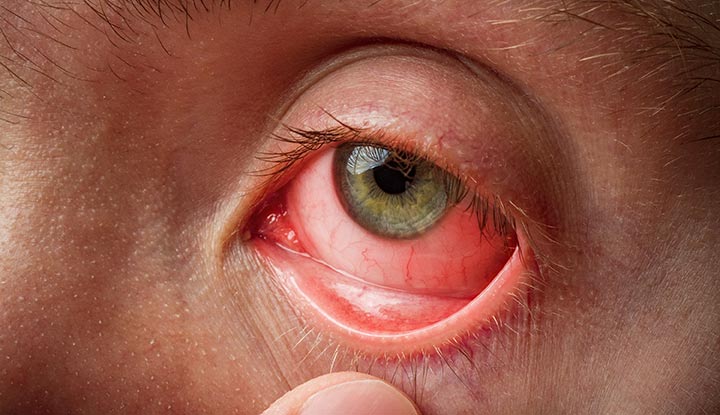 10 Essential Tips to Prevent and Treat Eye Infections