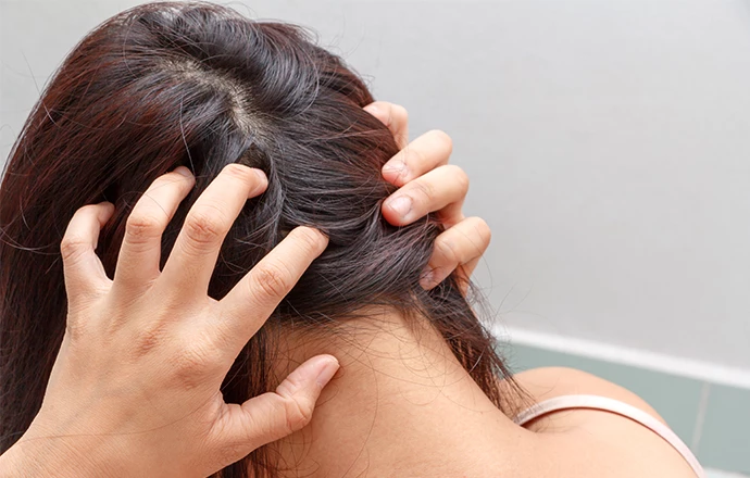 The Surprising Link Between Diet and Dandruff: Key Facts You Must Know